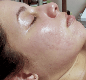 Nano-Needling after