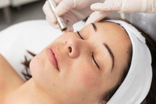 microdermabrasion